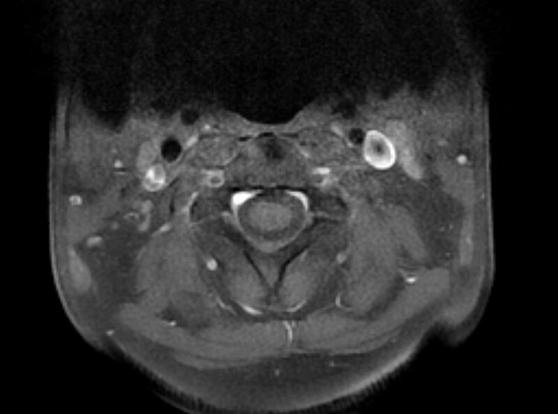 File:Cervical schwannoma (Radiopaedia 72399-82934 Axial T1 C+ fat sat 2).jpg