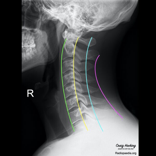 File:Cervical spine lines (Radiopaedia 76069-87571 A 1).jpeg