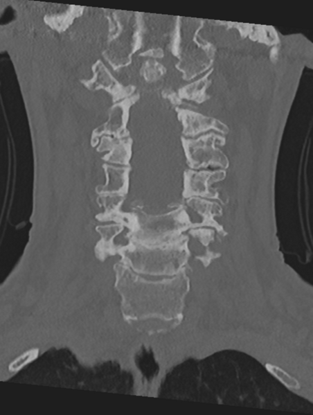File:Cervical spondylolysis (Radiopaedia 49616-54811 Coronal bone window 21).png