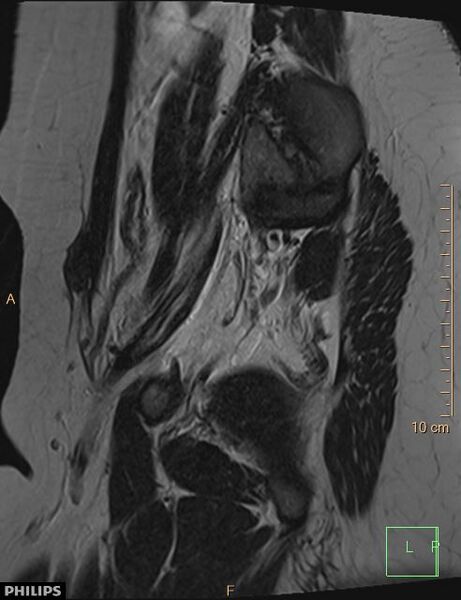 File:Cesarian scar endometriosis (Radiopaedia 68495-78066 Sagittal T2 25).jpg