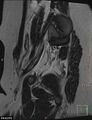 Cesarian scar endometriosis (Radiopaedia 68495-78066 Sagittal T2 25).jpg