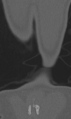 Chance fracture (Radiopaedia 40360-42912 Coronal bone window 73).png