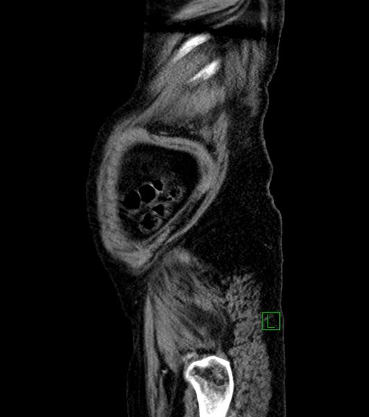 File:Cholangiocarcinoma with cerebral metastases (Radiopaedia 83519-98629 F 108).jpg