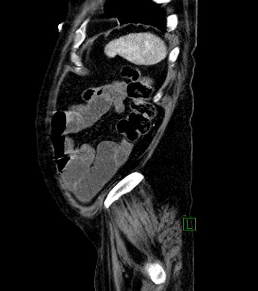 File:Cholangiocarcinoma with cerebral metastases (Radiopaedia 83519-98629 F 20).jpg