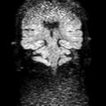 Cholesteatoma (Radiopaedia 10742-11204 Coronal DWI 13).jpg