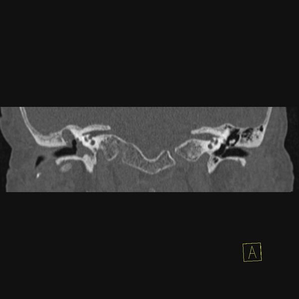 File:Cholesteatomatous chronic otitis (Radiopaedia 14993-14911 Coronal bone window 12).JPEG