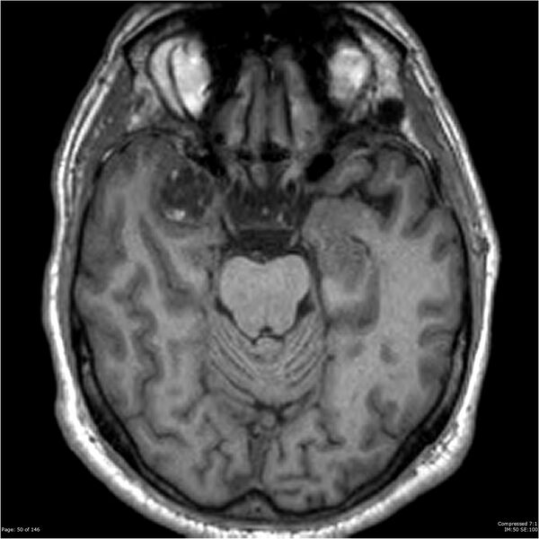 File:Chondrosarcoma of skull base- grade II (Radiopaedia 40948-43654 Axial T1 50).jpg