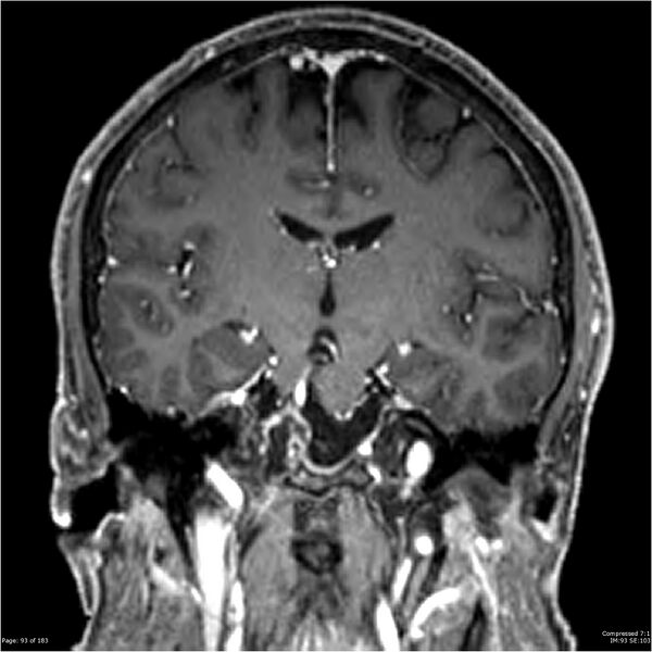 File:Chondrosarcoma of skull base- grade II (Radiopaedia 40948-43654 Coronal T1 C+ 4).jpg