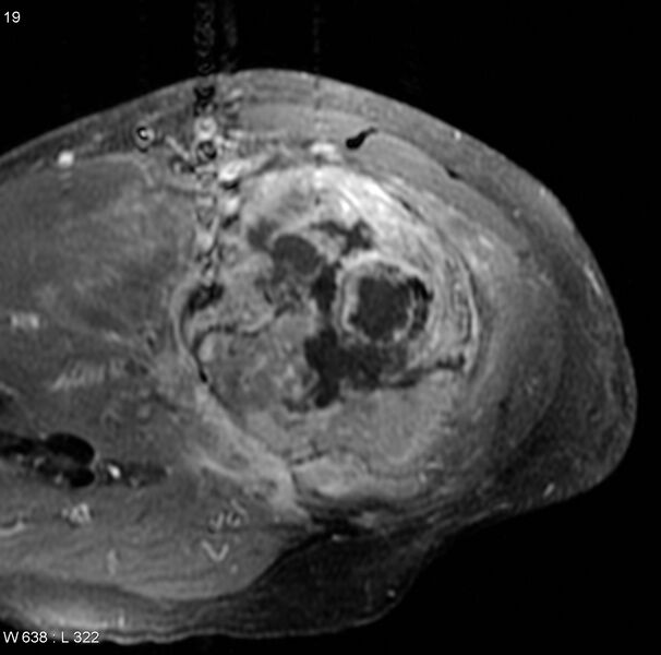 File:Chondrosarcoma with pathological fracture - femur (Radiopaedia 6174-7629 Axial T1 C+ 1).jpg