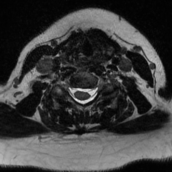 File:Chordoma - cervical spine (Radiopaedia 70084-80111 Axial T2 57).png