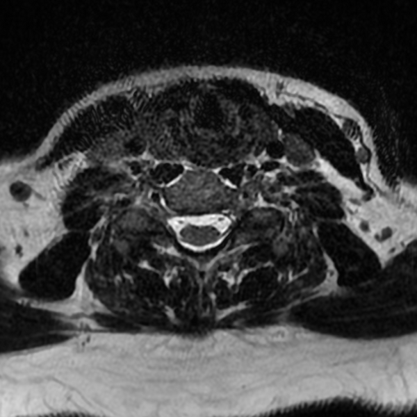 File:Chordoma - cervical spine (Radiopaedia 70084-80111 Axial T2 65).png