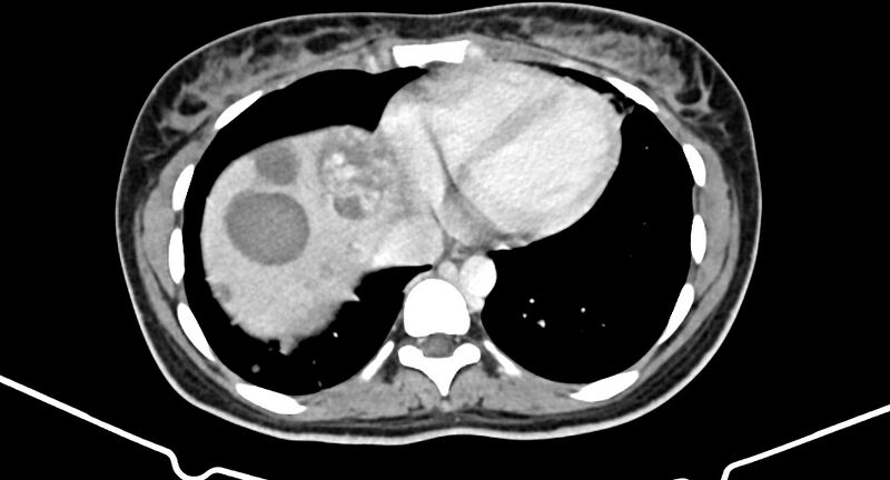 File:Choriocarcinoma liver metastases (Radiopaedia 74768-85766 A 20).jpg