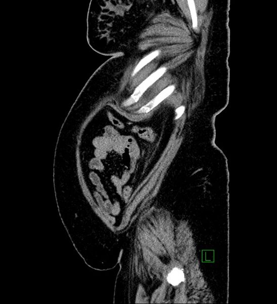 File:Chromophobe renal cell carcinoma (Radiopaedia 84239-99519 G 17).jpg