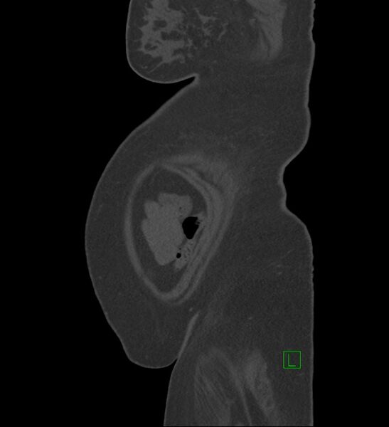 File:Chromophobe renal cell carcinoma (Radiopaedia 84239-99519 Sagittal bone window 2).jpg