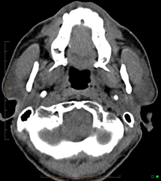File:Chronic Submandibular sialolithiasis (Radiopaedia 16880-16606 Axial non-contrast 1).jpg