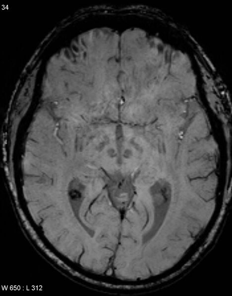 File:Chronic lymphocytic inflammation with pontine perivascular enhancement responsive to steroids (CLIPPERS) (Radiopaedia 37520-39374 Axial SWI 33).jpg