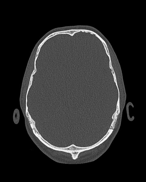 File:Chronic maxillary sinusitis caused by a foreign body (Radiopaedia 58521-65676 Axial bone window 327).jpg