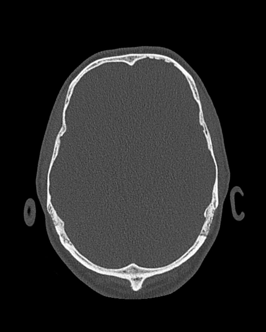 Chronic maxillary sinusitis caused by a foreign body (Radiopaedia 58521-65676 Axial bone window 327).jpg