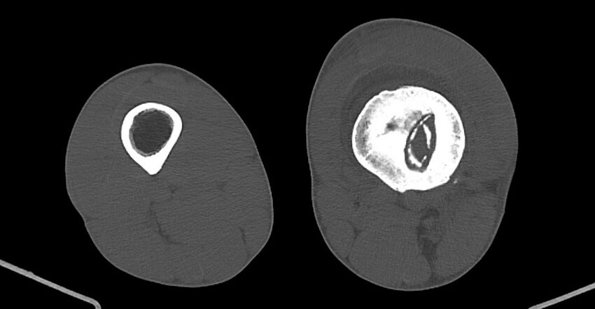Chronic osteomyelitis (with sequestrum) (Radiopaedia 74813-85822 Axial non-contrast 139).jpg