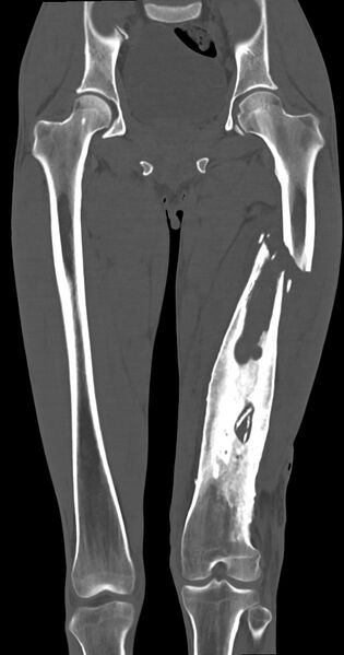 File:Chronic osteomyelitis (with sequestrum) (Radiopaedia 74813-85822 Coronal non-contrast 28).jpg