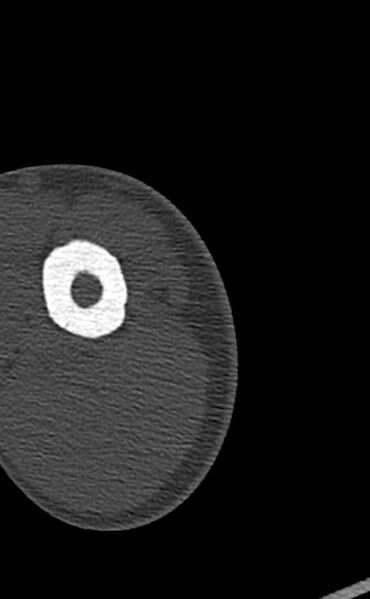 File:Chronic osteomyelitis of the distal humerus (Radiopaedia 78351-90971 Axial bone window 11).jpg