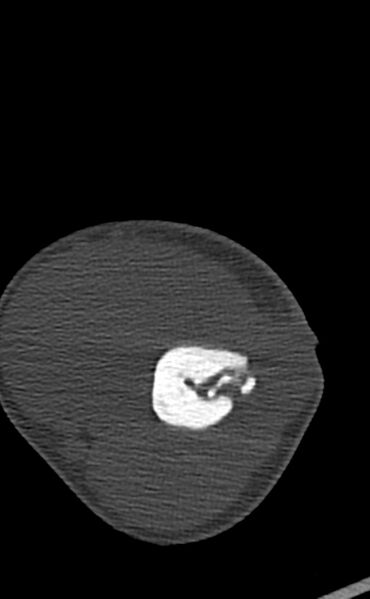 File:Chronic osteomyelitis of the distal humerus (Radiopaedia 78351-90971 Axial bone window 58).jpg