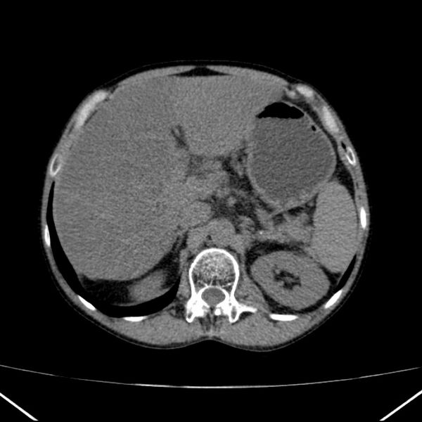 File:Chronic pancreatitis (Radiopaedia 23132-23172 Axial non-contrast 22).jpg