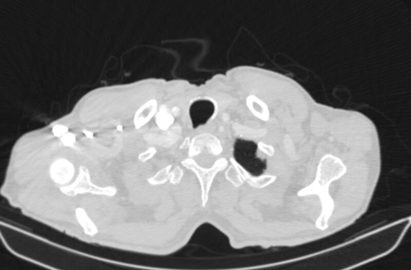File:Chronic pulmonary embolism (Radiopaedia 91241-108843 Axial lung window 1).jpg
