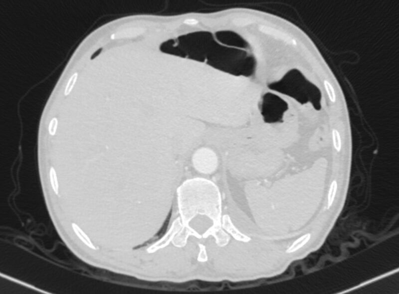 File:Chronic pulmonary embolism with bubbly consolidation (Radiopaedia 91248-108850 Axial lung window 142).jpg