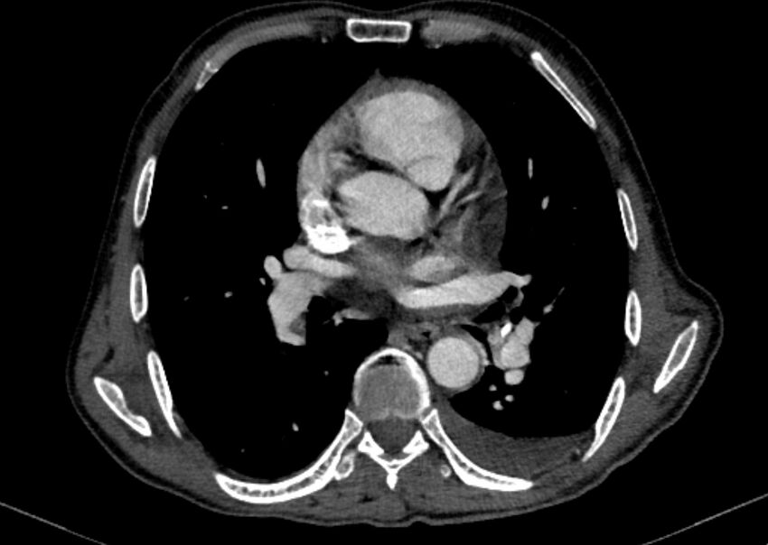 Chronic pulmonary embolism with bubbly consolidation (Radiopaedia 91248-108850 C+ arterial phase 80).jpg