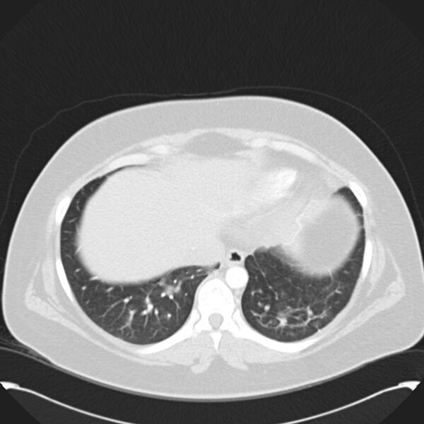 File:Chronic thromboembolic pulmonary hypertension (CTEPH) (Radiopaedia 74597-85531 Axial lung window 41).jpg