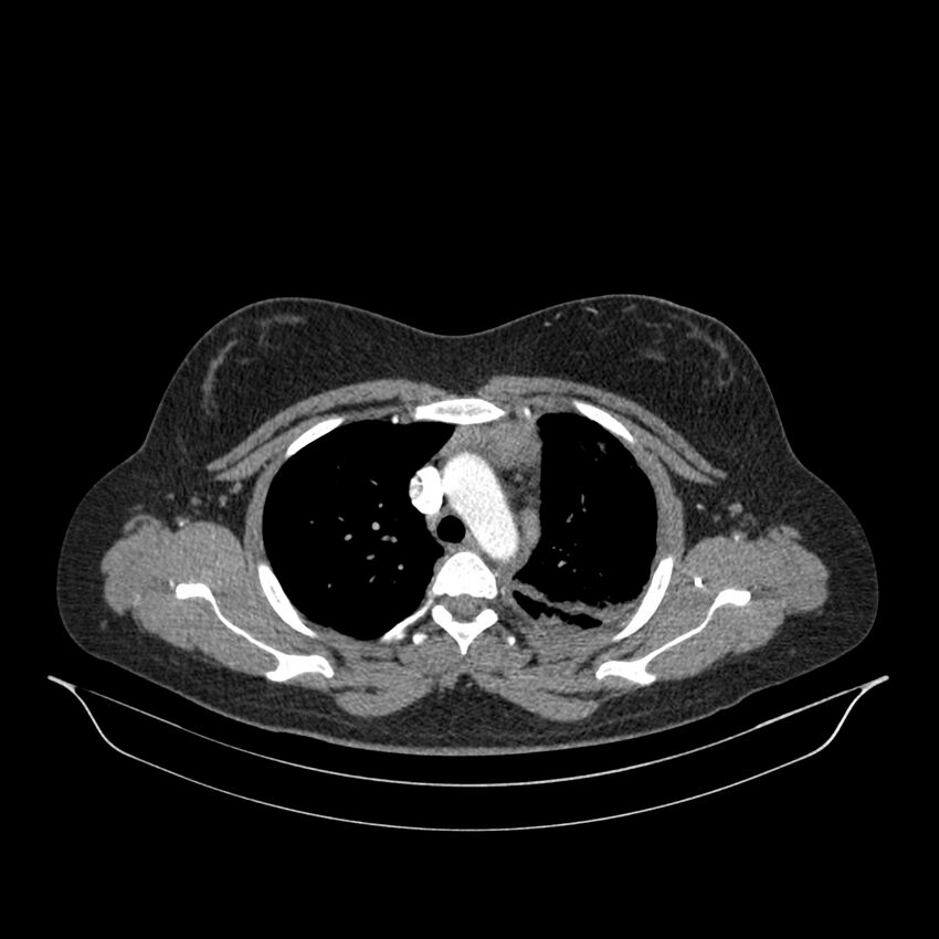 Chronic thromboembolic pulmonary hypertension (CTEPH) (Radiopaedia 74597-85532 Axial C+ CTPA 116).jpg