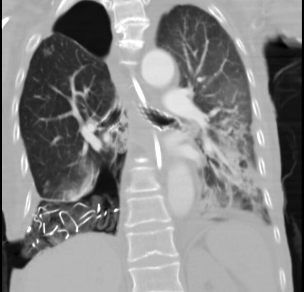 File:Clagett thoracotomy with bronchopleural fistula (Radiopaedia 29192-29587 Coronal lung window 12).jpg