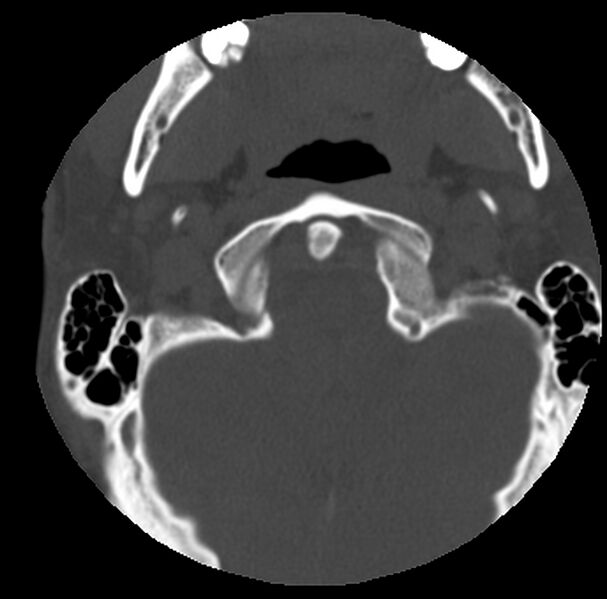 File:Clay-shoveler fracture (Radiopaedia 22568-22590 Axial bone window 5).jpg
