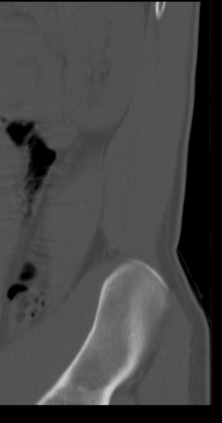 File:Clear cell meningoma - lumbar spine (Radiopaedia 60116-67691 Sagittal bone window 2).png