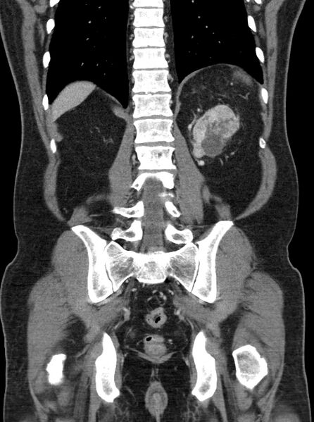 File:Clear cell renal cell carcinoma (Radiopaedia 61449-69393 F 42).jpg