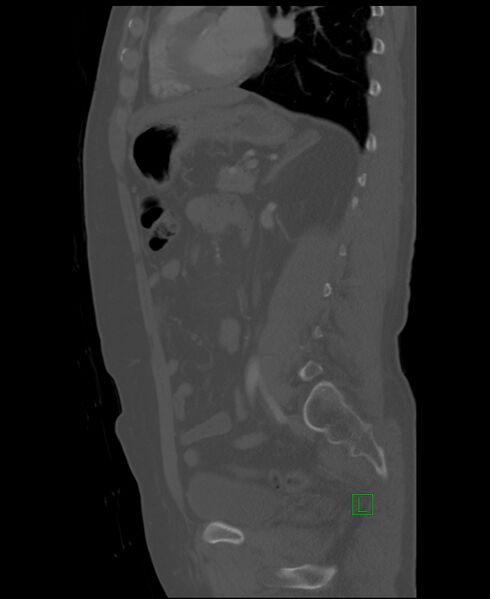 File:Clear cell renal cell carcinoma (Radiopaedia 85006-100539 Sagittal bone window 23).jpg