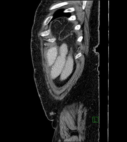 File:Closed-loop small bowel obstruction-internal hernia (Radiopaedia 78439-91096 C 22).jpg