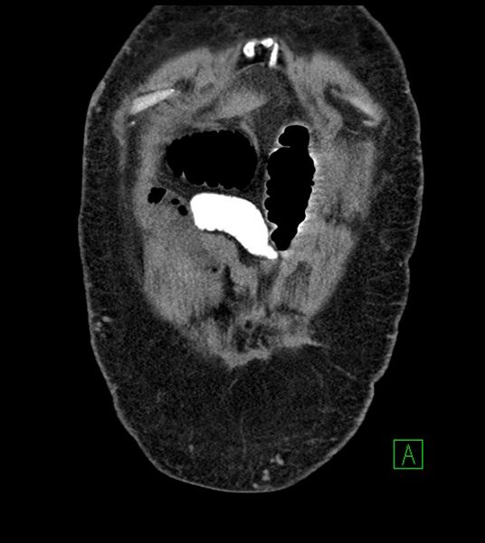 File:Closed-loop small bowel obstruction-internal hernia (Radiopaedia 78439-91096 Coronal non-contrast 19).jpg