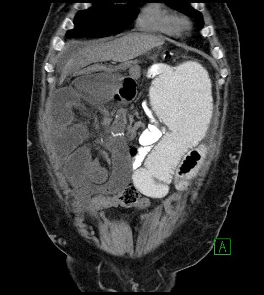 File:Closed-loop small bowel obstruction-internal hernia (Radiopaedia 78439-91096 Coronal non-contrast 29).jpg