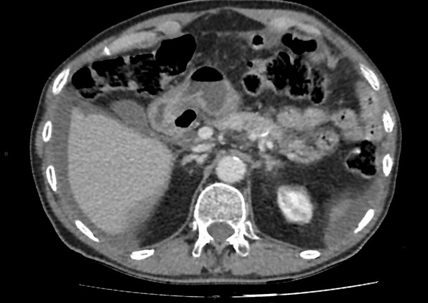 Closed loop small bowel obstruction with ischemia (Radiopaedia 84180-99456 A 31).jpg