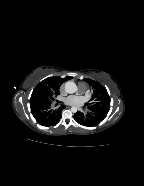 File:Coarctation of the aorta (Radiopaedia 27458-27657 D 13).jpg