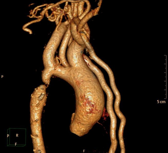 File:Coarctation of the aorta (Radiopaedia 27458-27657 Sagittal 3D 1).jpg