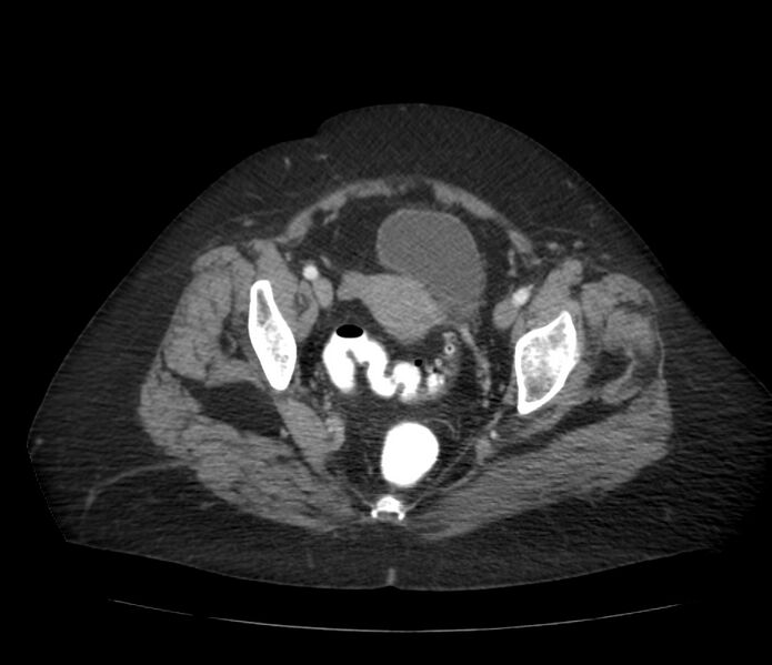 File:Colonic diverticulosis (Radiopaedia 22934-22957 A 65).jpg