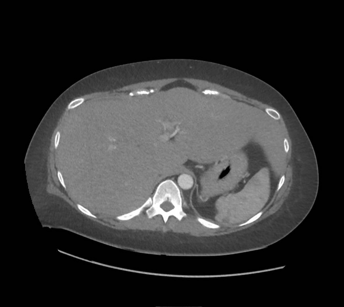 File:Colonic pseudo-obstruction (Radiopaedia 79752-92980 A 38).png