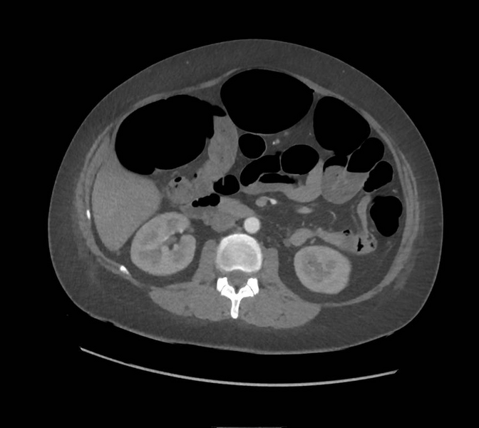 File:Colonic pseudo-obstruction (Radiopaedia 79752-92980 A 84).png