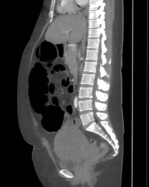 File:Colonic pseudo-obstruction (Radiopaedia 79752-92980 C 39).png