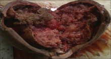 Gross picture of uterus showing uterine cavity completely replaced by grape-like vesicles