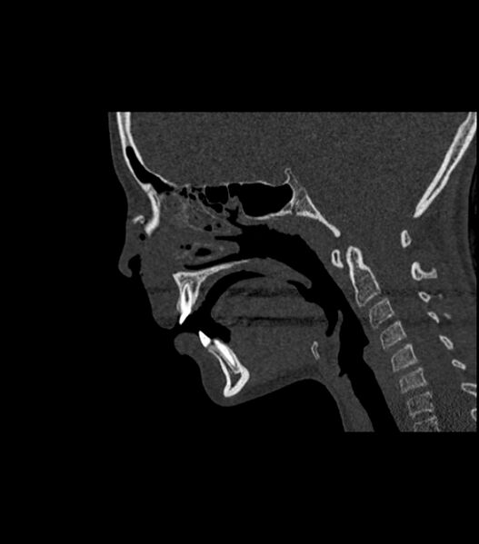 File:Nasoorbitoethmoid fracture (Radiopaedia 90044-107205 Sagittal bone window 69).jpg
