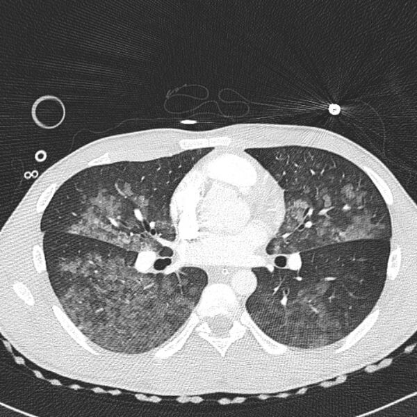 File:Near drowning (pulmonary edema) (Radiopaedia 24685-24958 lung window 33).jpg